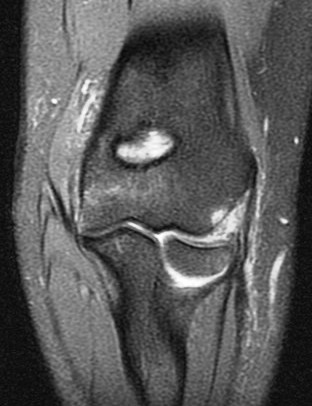 Figure 2 for case Tear of combined origin of the lateral ulnar collateral ligament and radial collateral of elbow (RID2043)(RID2035)